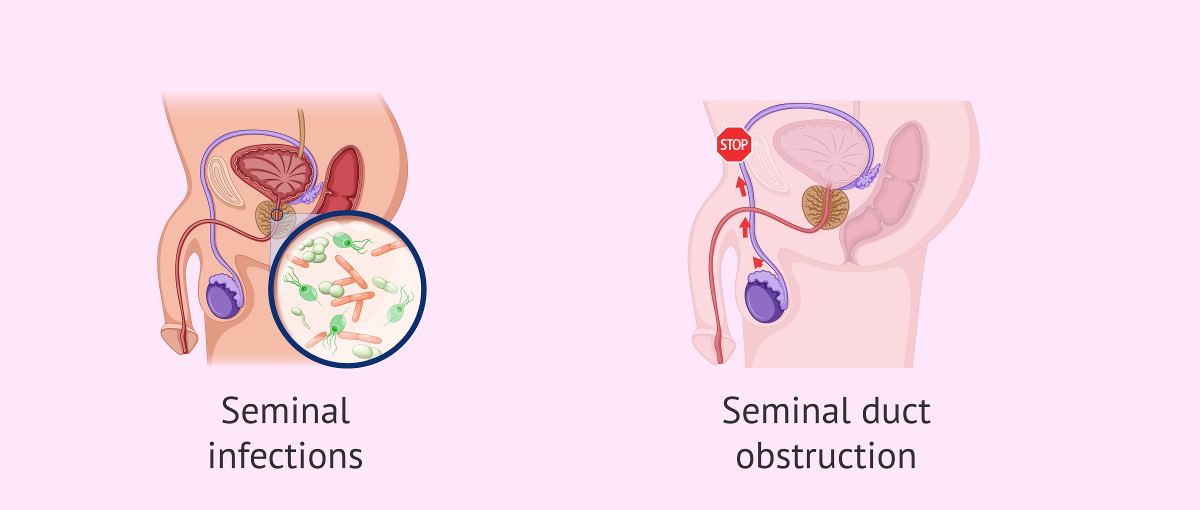 Oligospermia due to post-testicular causes