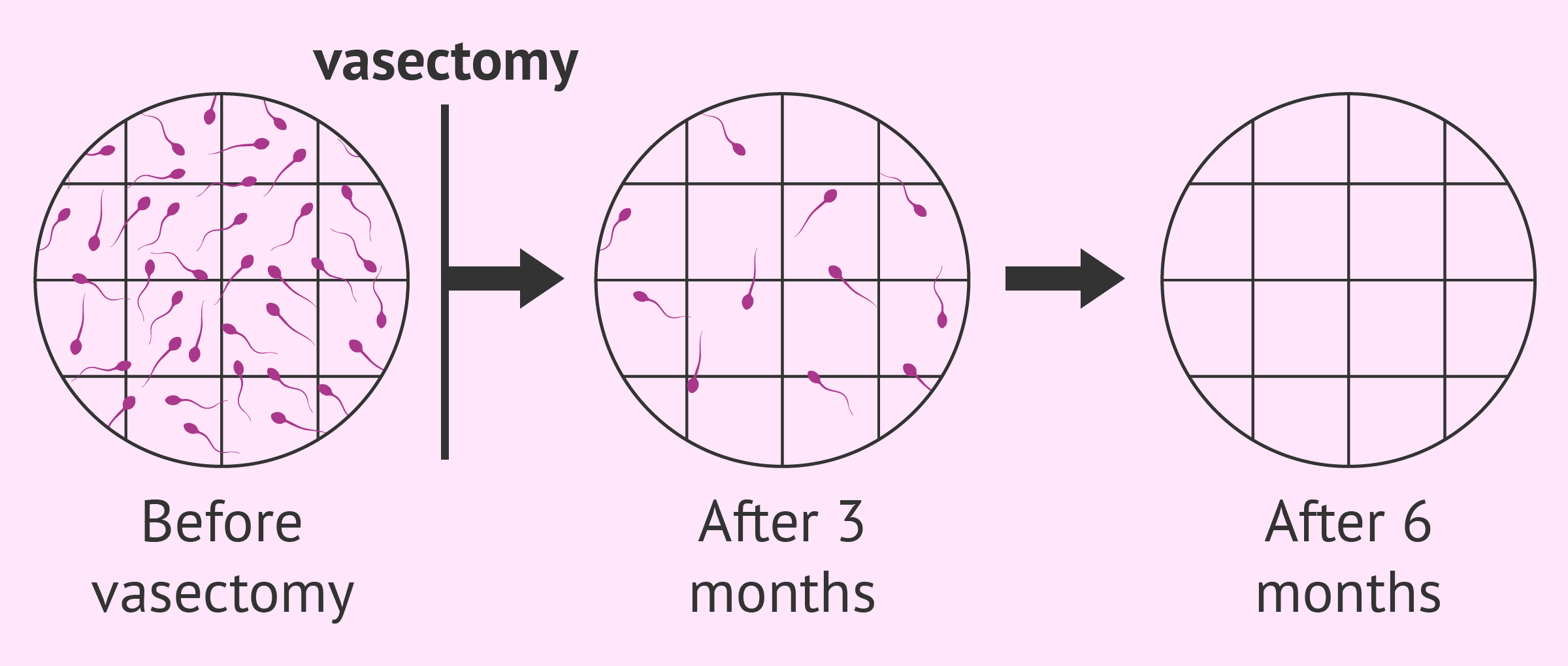 Post vasectomy sperm tests