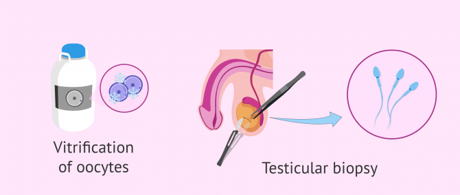 Imagen: Sperm collection options