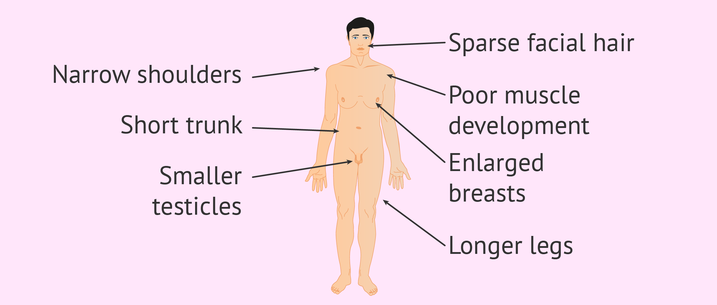 Klinefelter Syndrome (XXY Syndrome) - Symptoms, Causes & Fertility