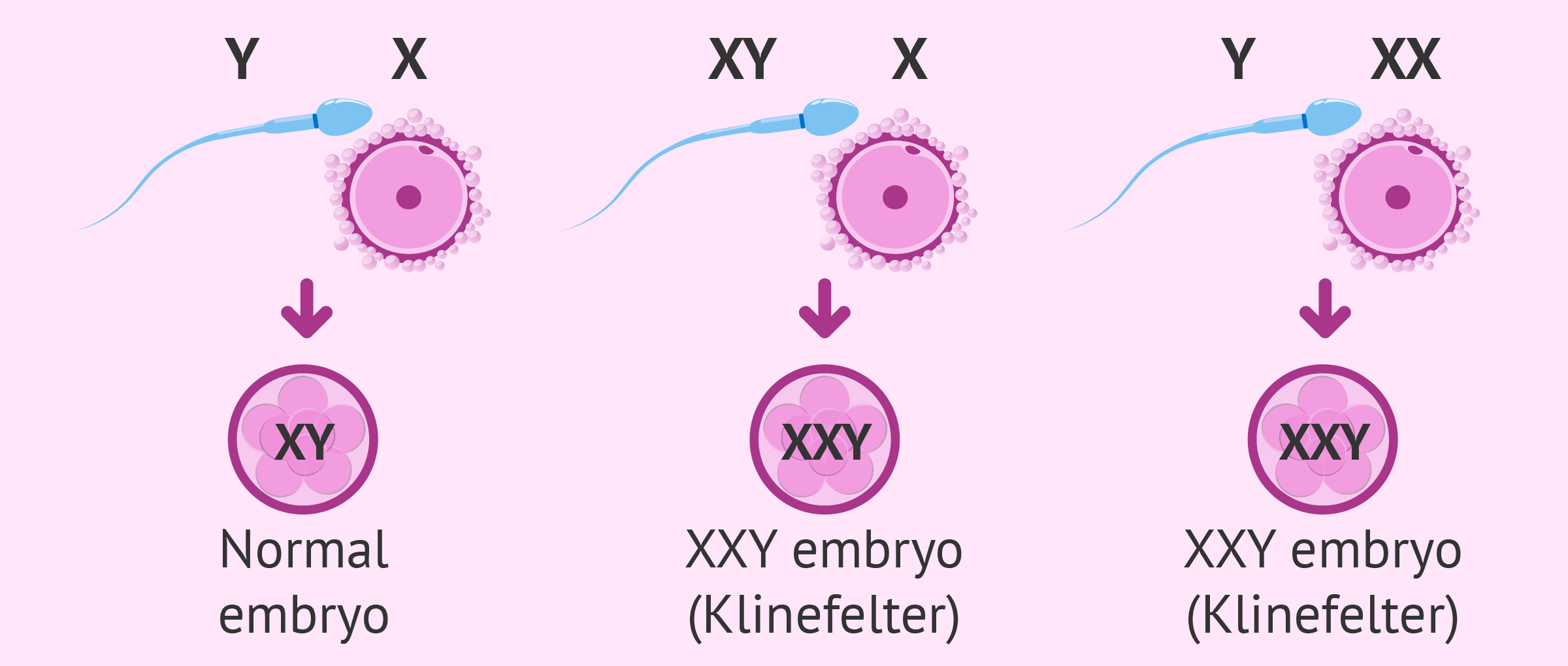 Symptoms Of Klinefelter Syndrome Diagram