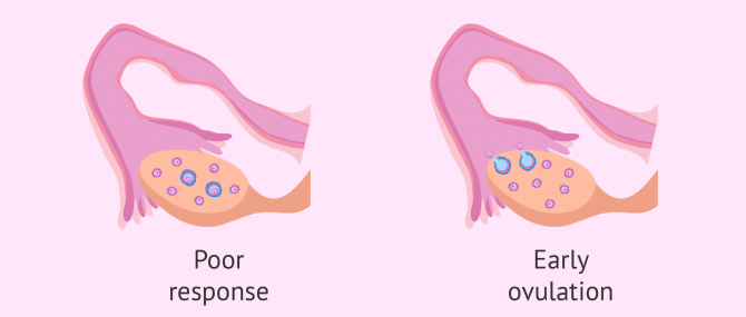 Low response to ovarian stimulation