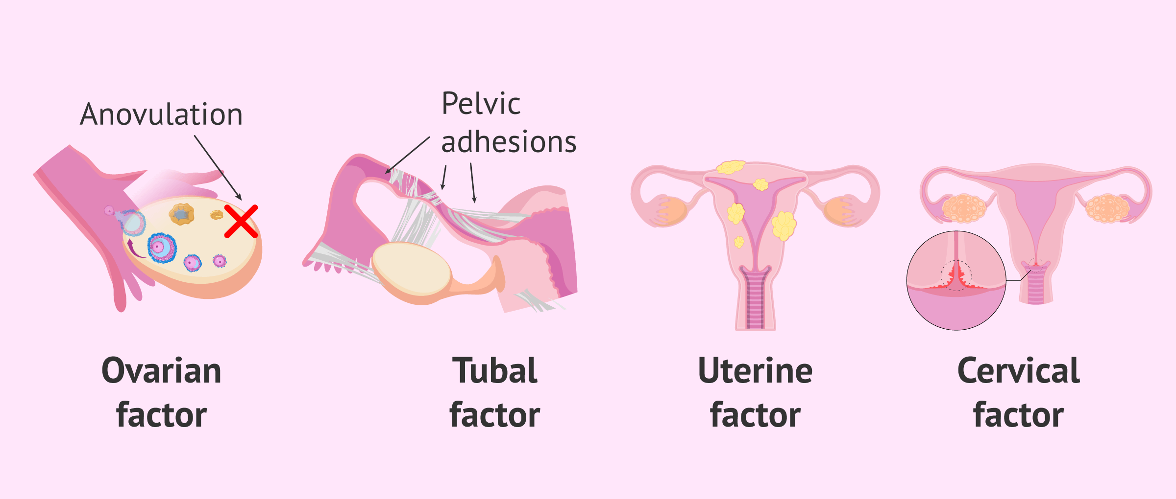 Causes Of Female Infertility