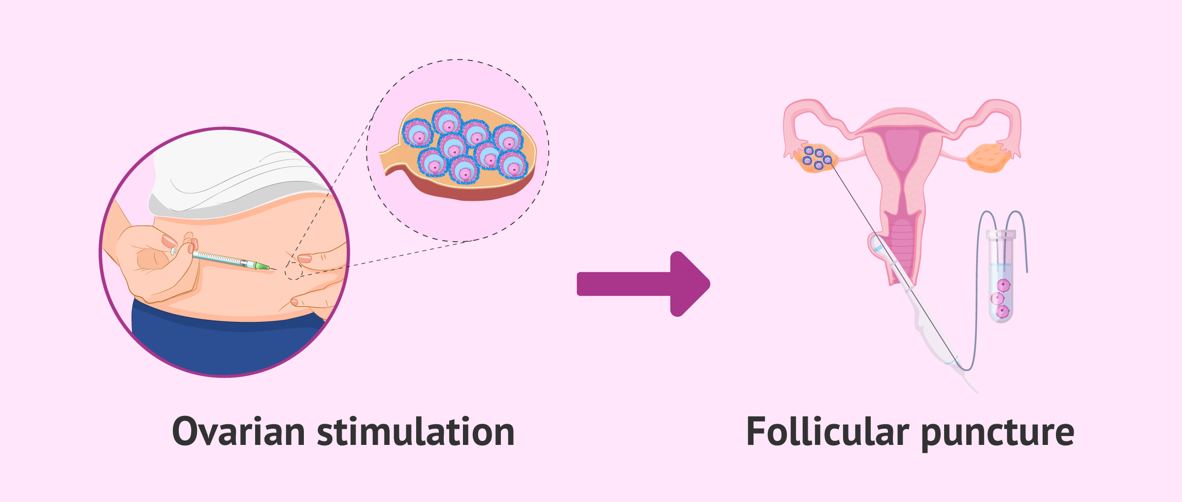 Follicular puncture after ovarian stimulation