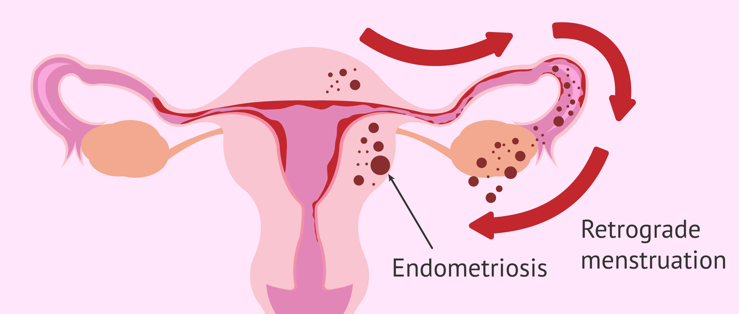 Normal Menstrual Cramps or Endometriosis: How to Tell the Difference:  OB-GYN Associates of Marietta: Obstetrics and Gynecologist