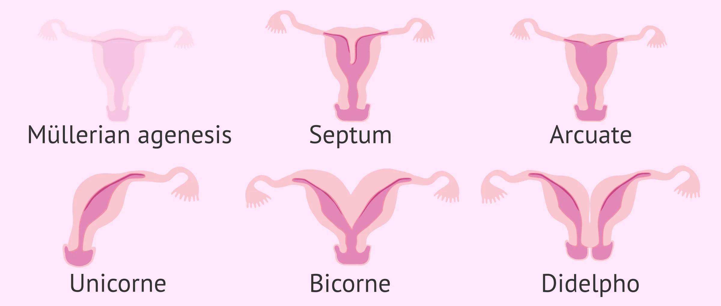 Uterine Factor Infertility