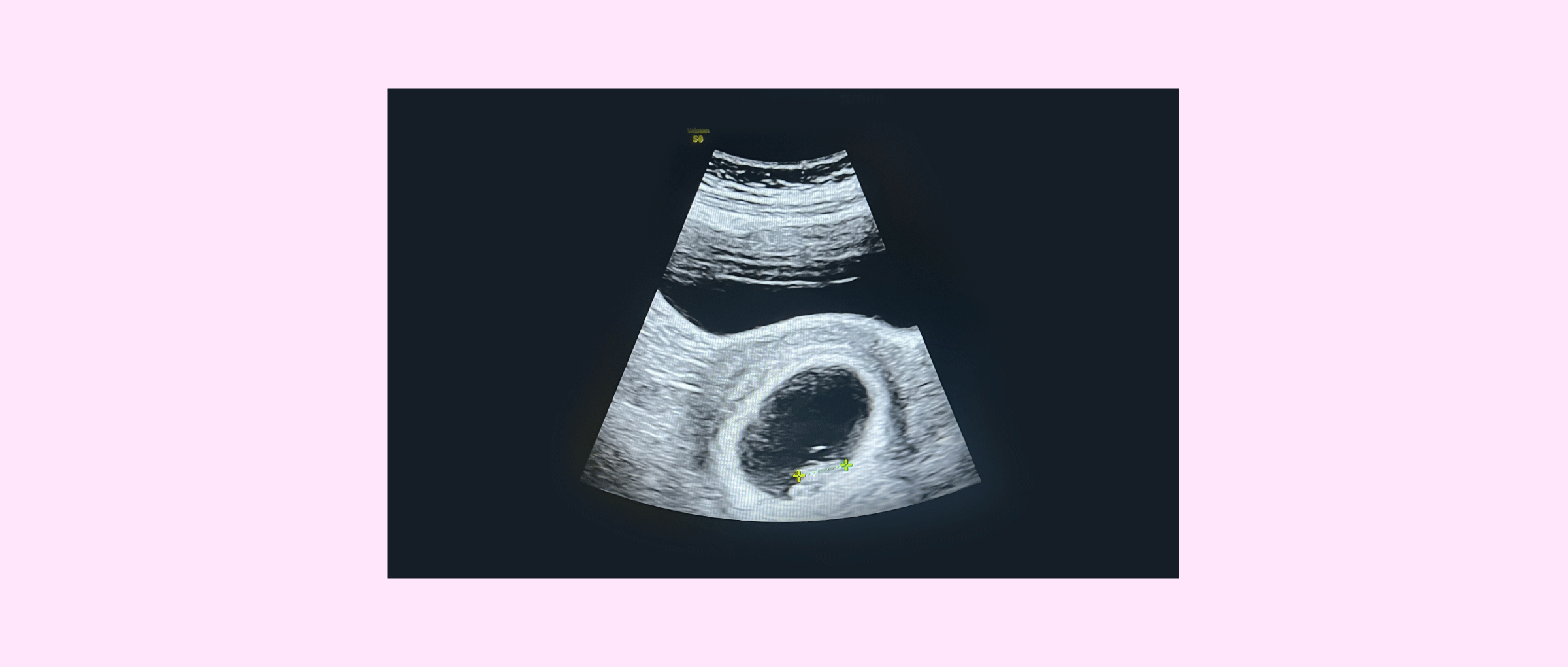 First gestational 2D ultrasound
