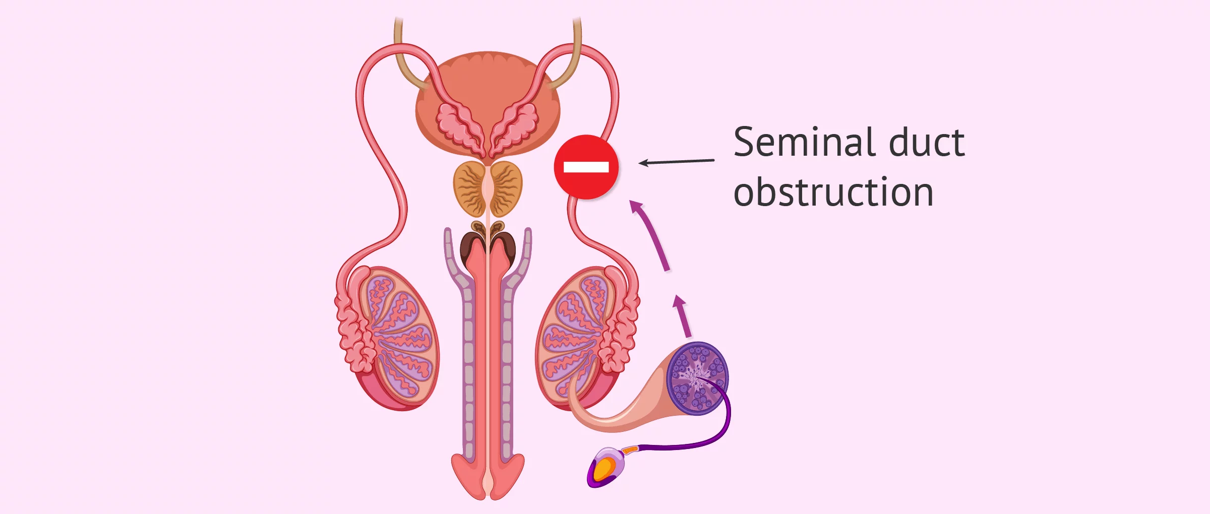Post-testicular cause in male sterility