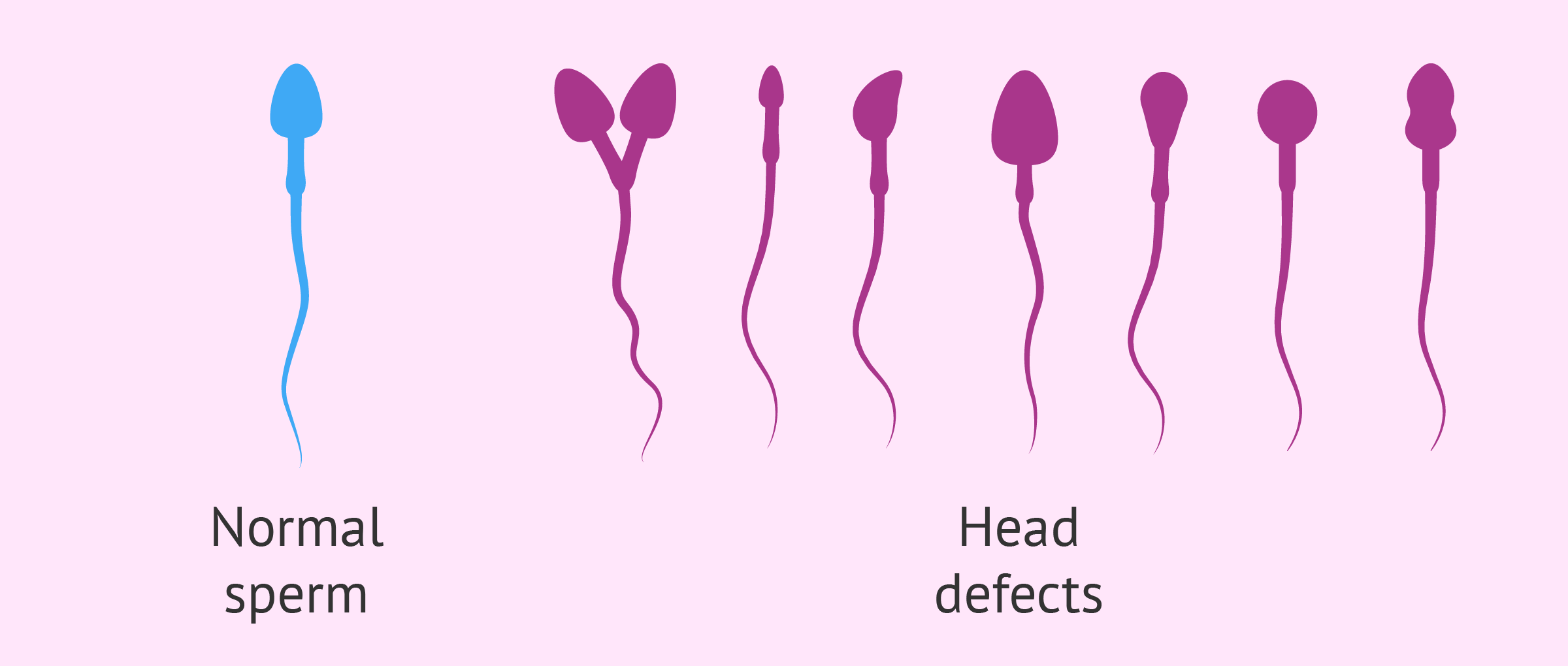 Head defects in sperm