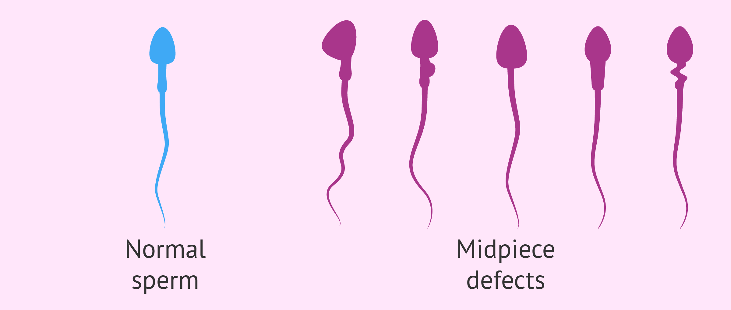 Midpiece defects in sperm