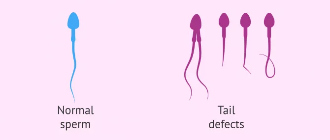 Tail defects in sperm