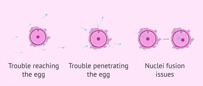 Fertilization failure caused by teratospermia