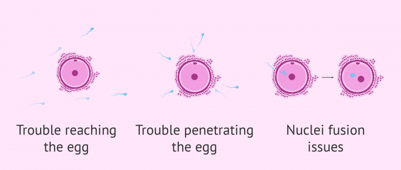 Teratozoospermia Types - Mild, Moderate & Severe