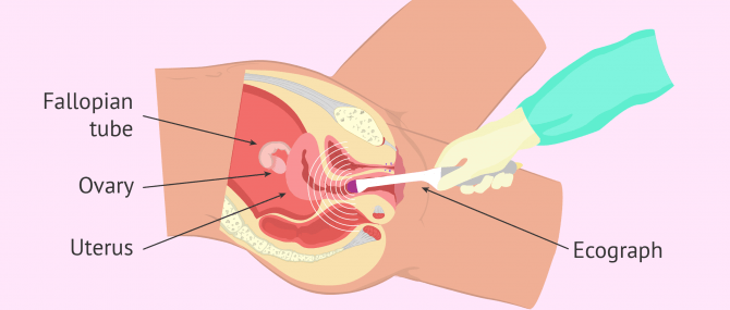 Appearance of ovaries through ultrasound scan