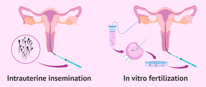 Assisted reproduction and PCOS