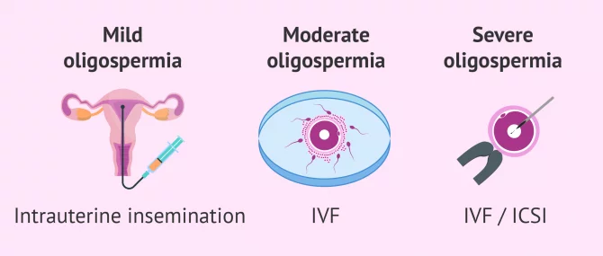 Assisted reproduction and oligospermia