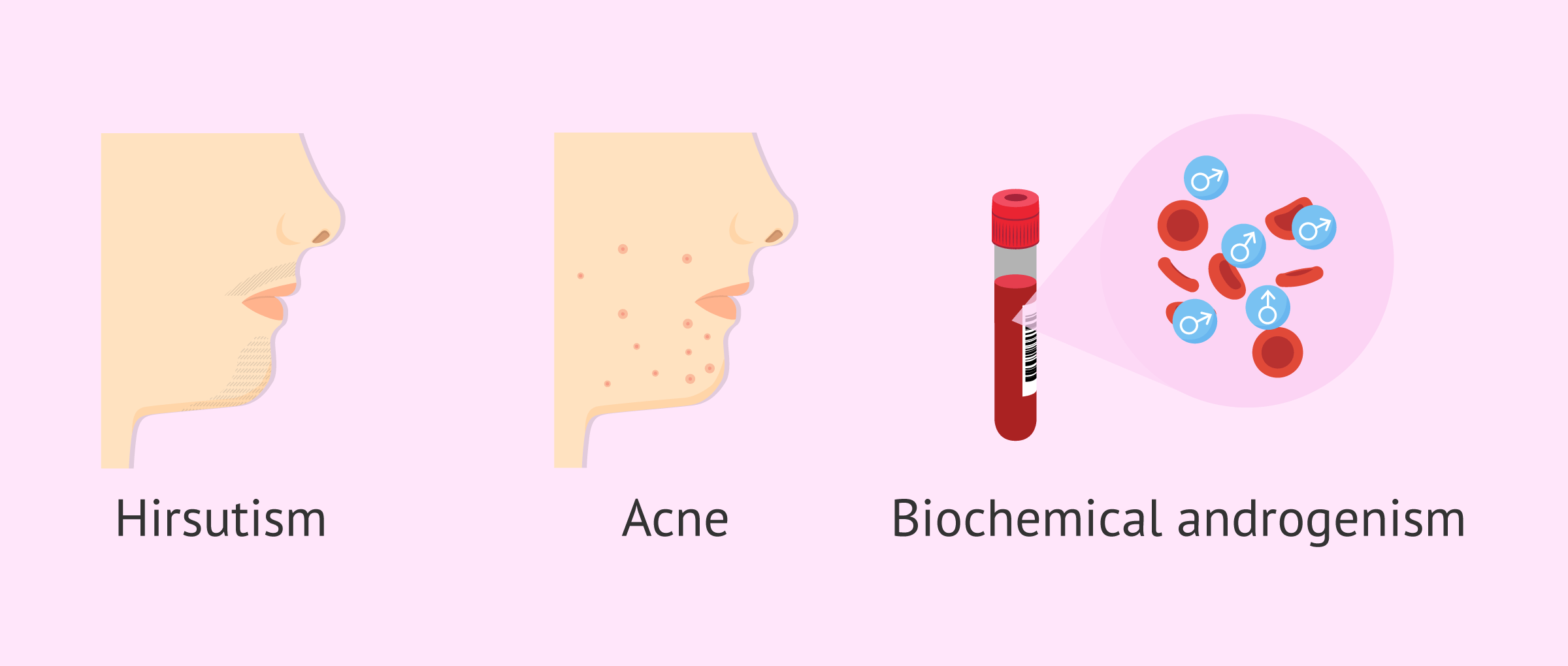 Imagen: Manifestations of hyperandrogenism