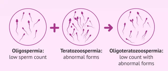 Oligoteratozoospermia