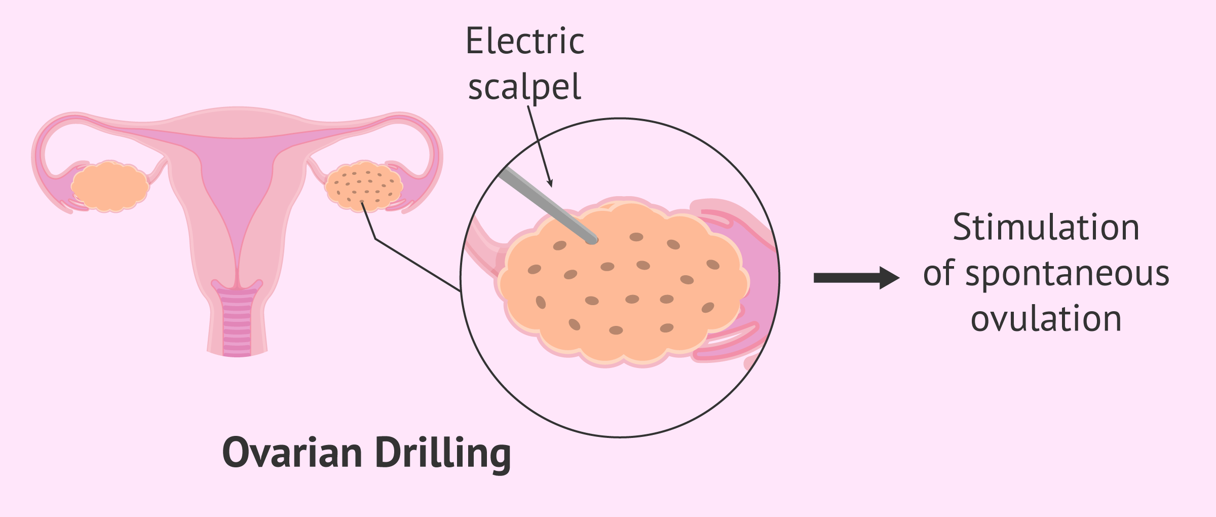 Imagen: Ovarian drilling to perforate the ovary