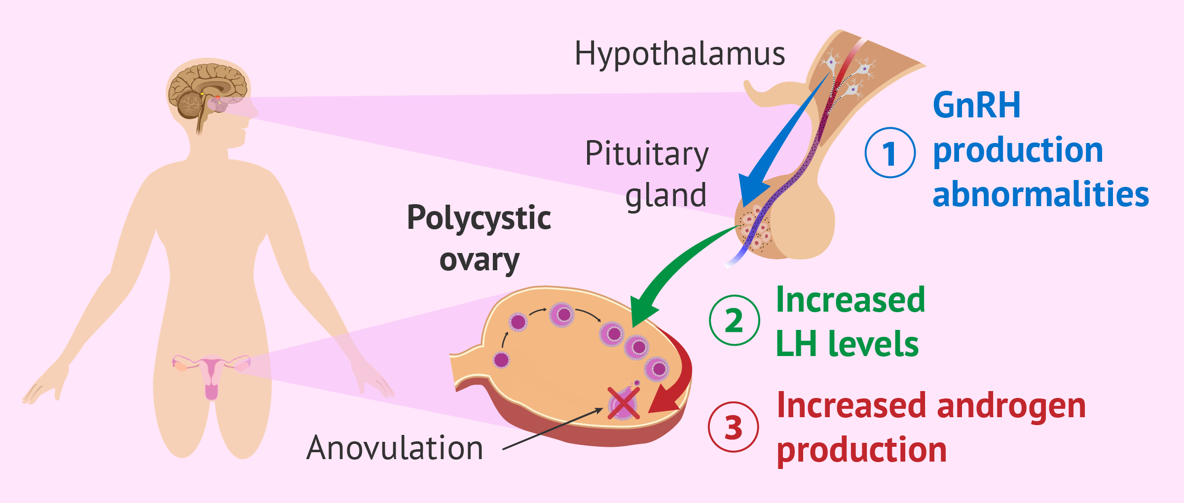 Endocrino especialista en ovarios poliquisticos