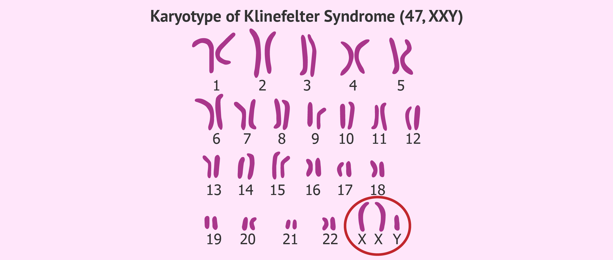 Karyotype Of Klinefelter Syndrome