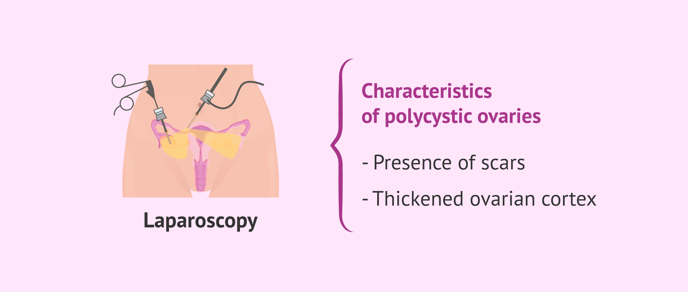 Imagen: Laparoscopy for the diagnosis of PCOS