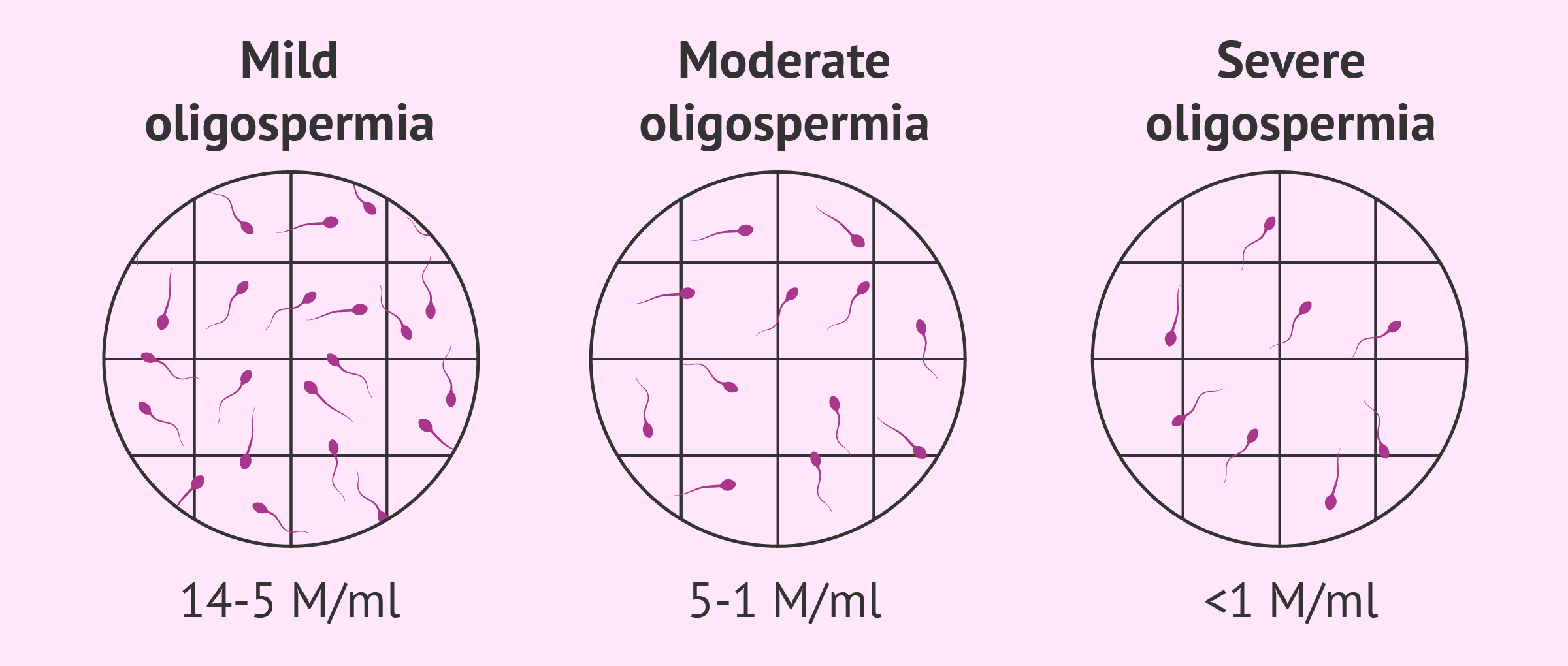 Mild, moderate and severe oligospermia