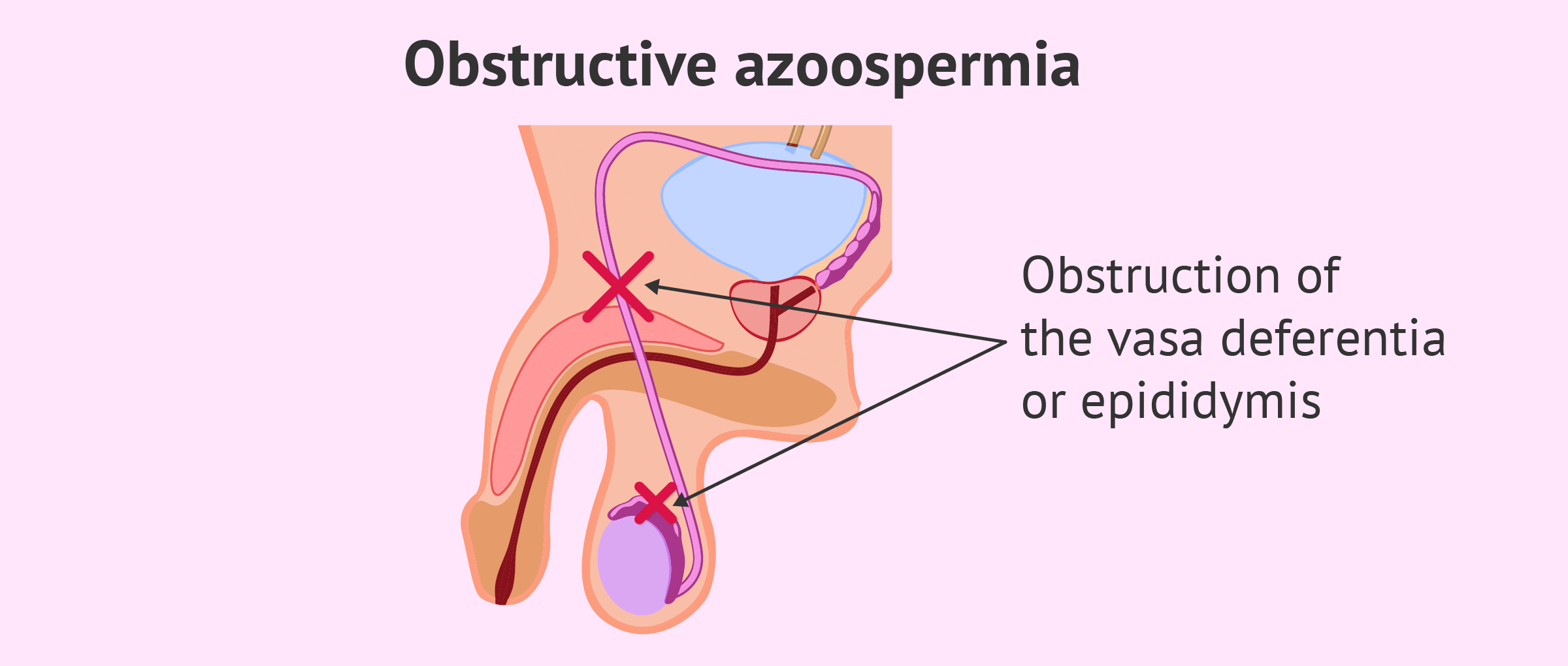 Obstructive Azoospermia - Causes & Treatment Options