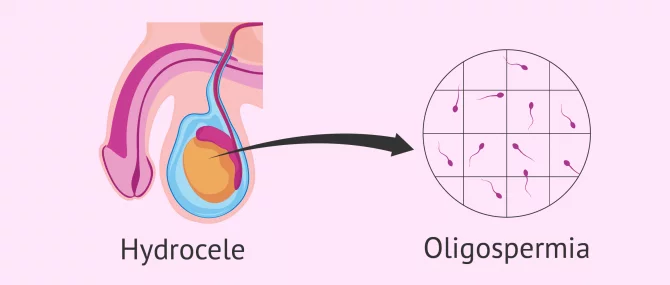 Oligozoospermia and hydrocele