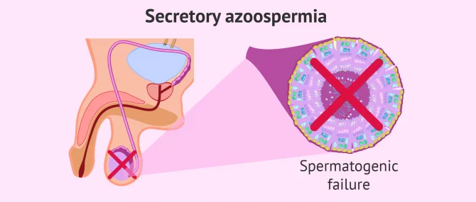 Secretory azoospermia
