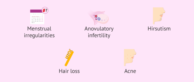 Imagen: Clinical manifestations of PCOS