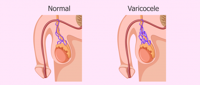 Varicocele and azoospermia