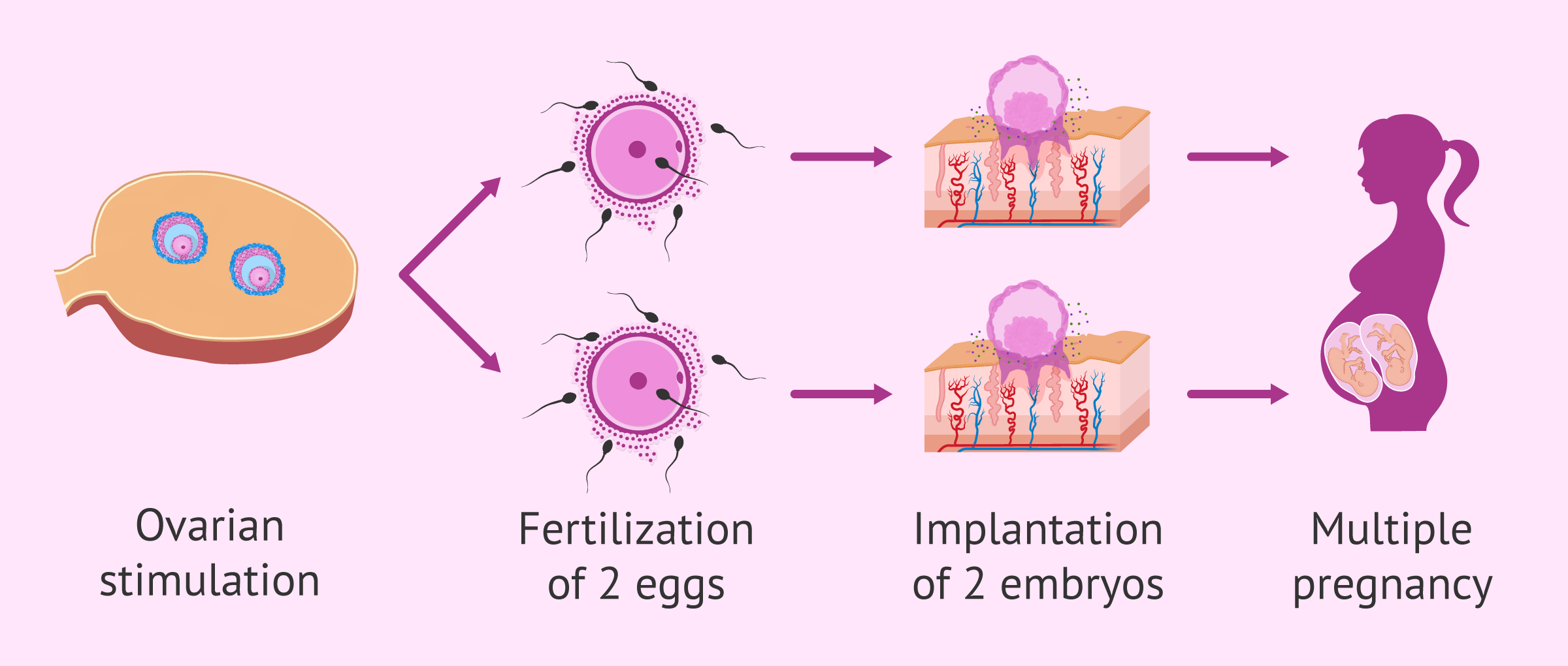 Multiple pregnancy following artificial insemination (AI)