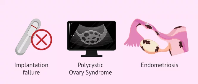Imagen: Infertility treatment acupuncture