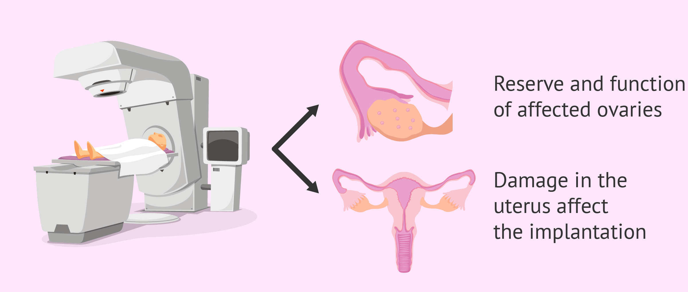 Radiotherapy and female infertility