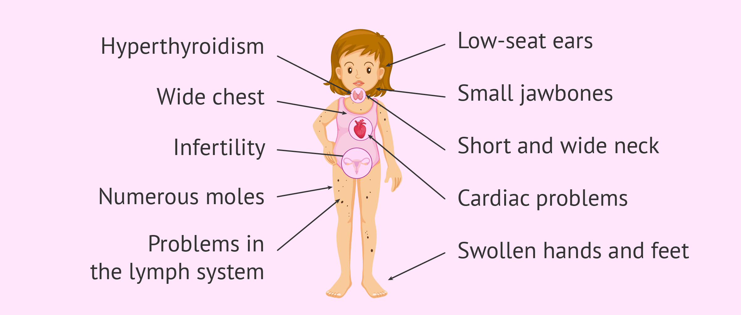 turner syndrome facts