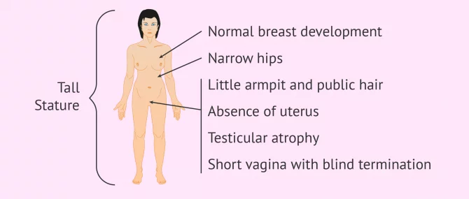 Imagen: physical characteristics Morris syndrome
