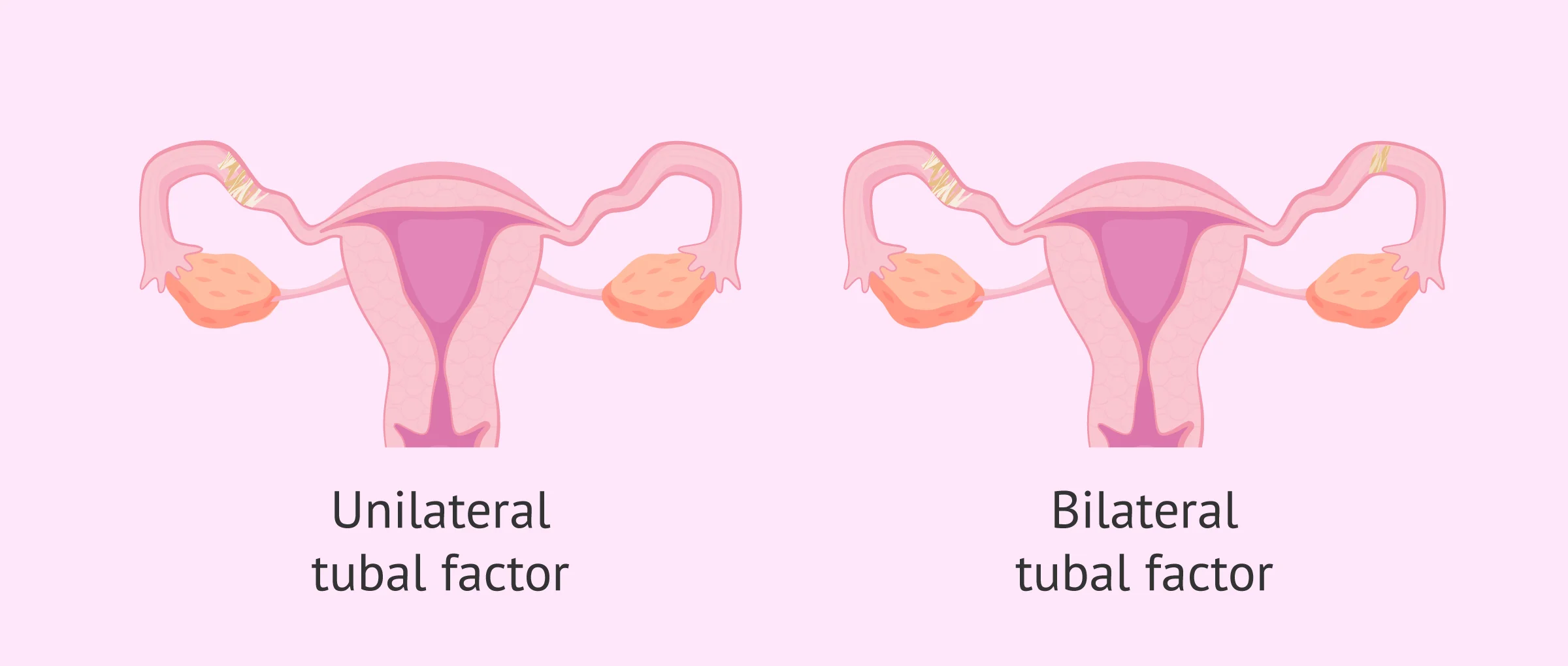 Tubal Factor Infertility