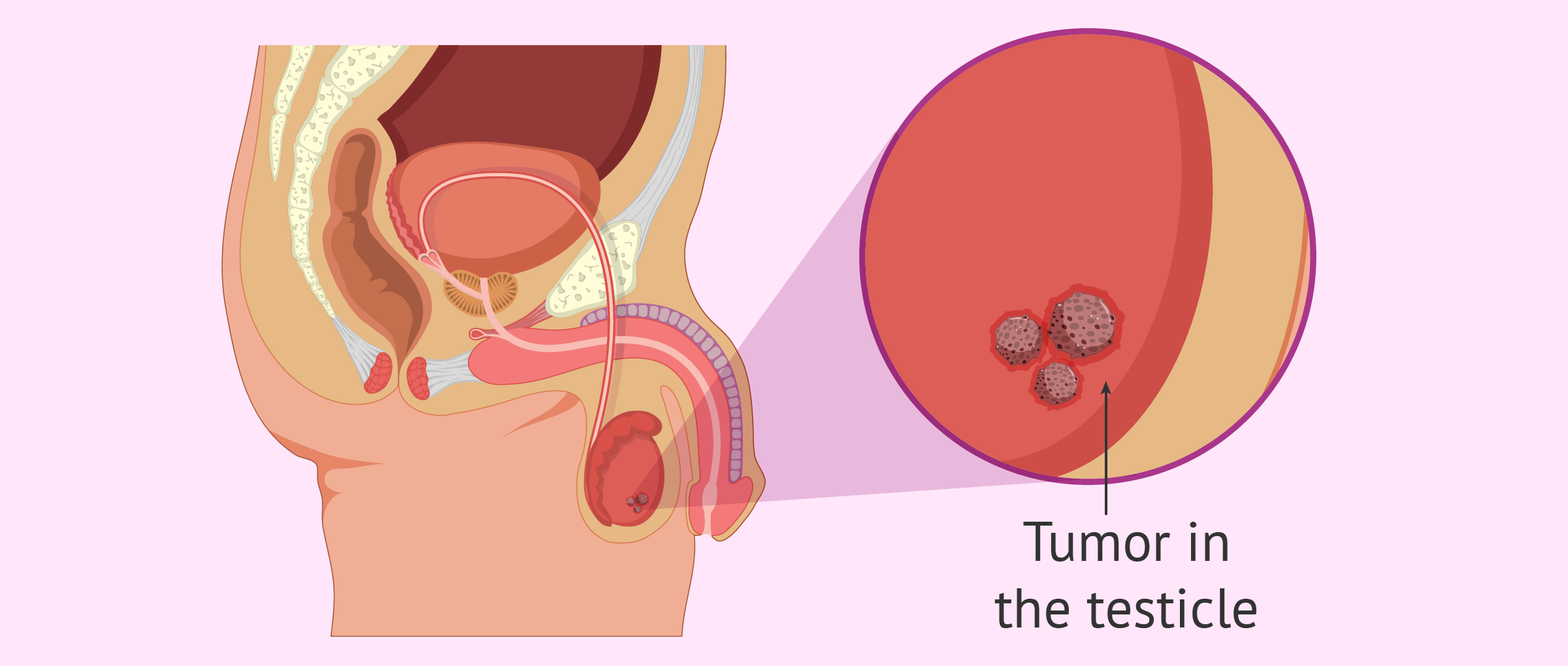 Scrotal masses Information