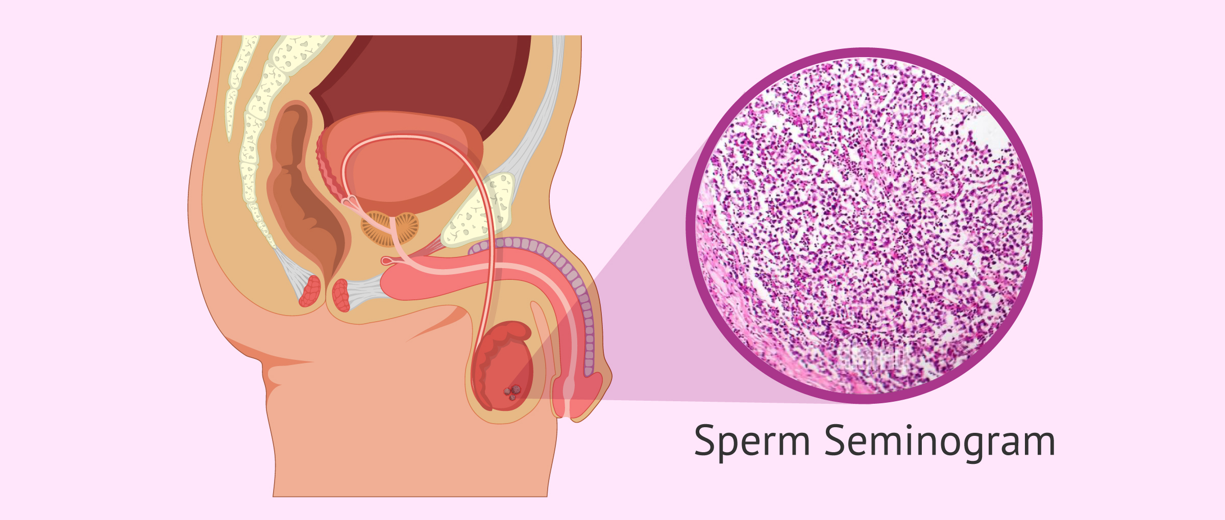 Spermatocytic seminoma