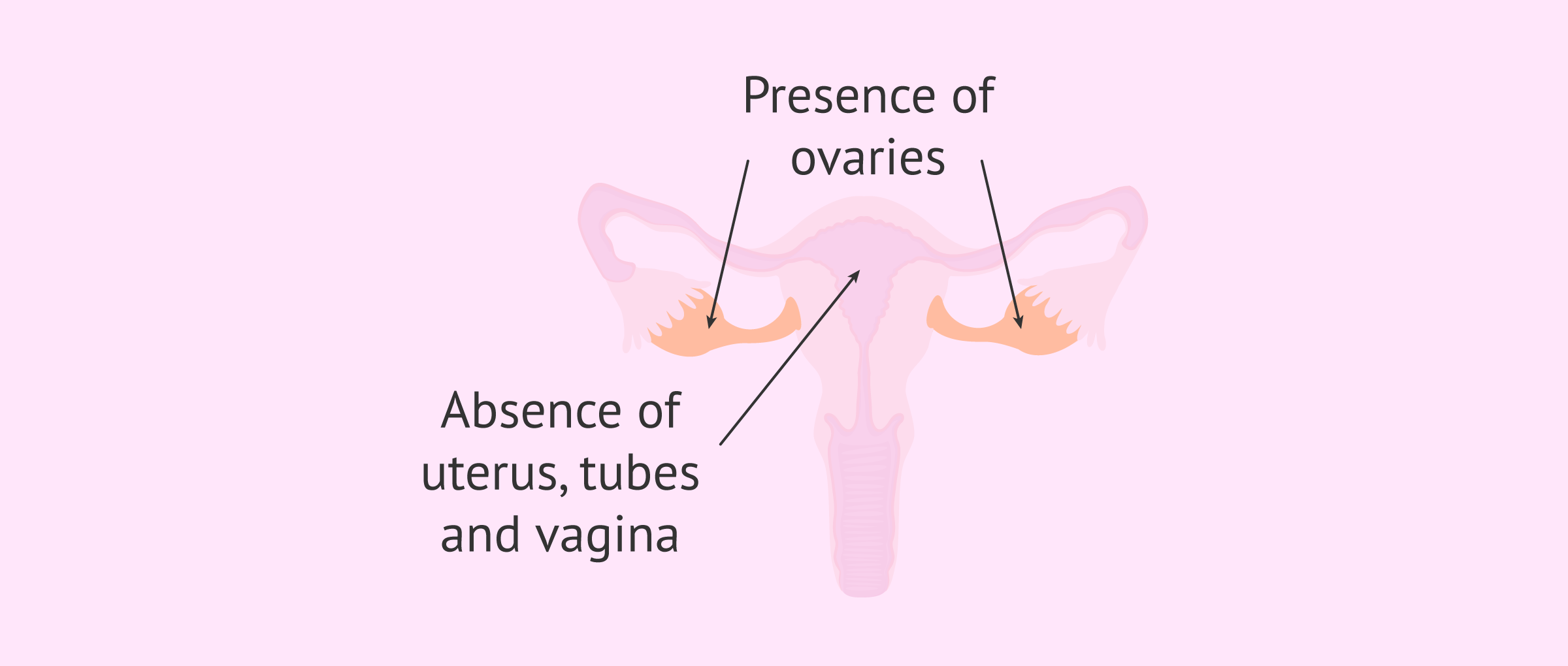 What is uterine agenesis?