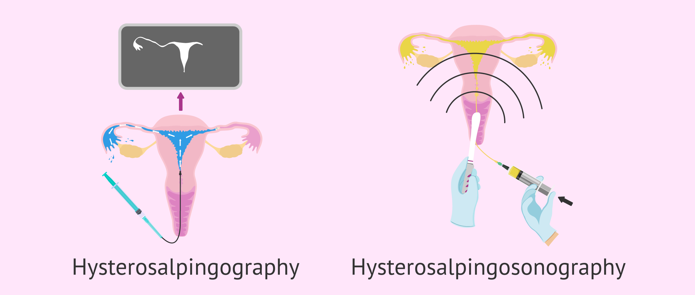 Types of hysterosalpingography