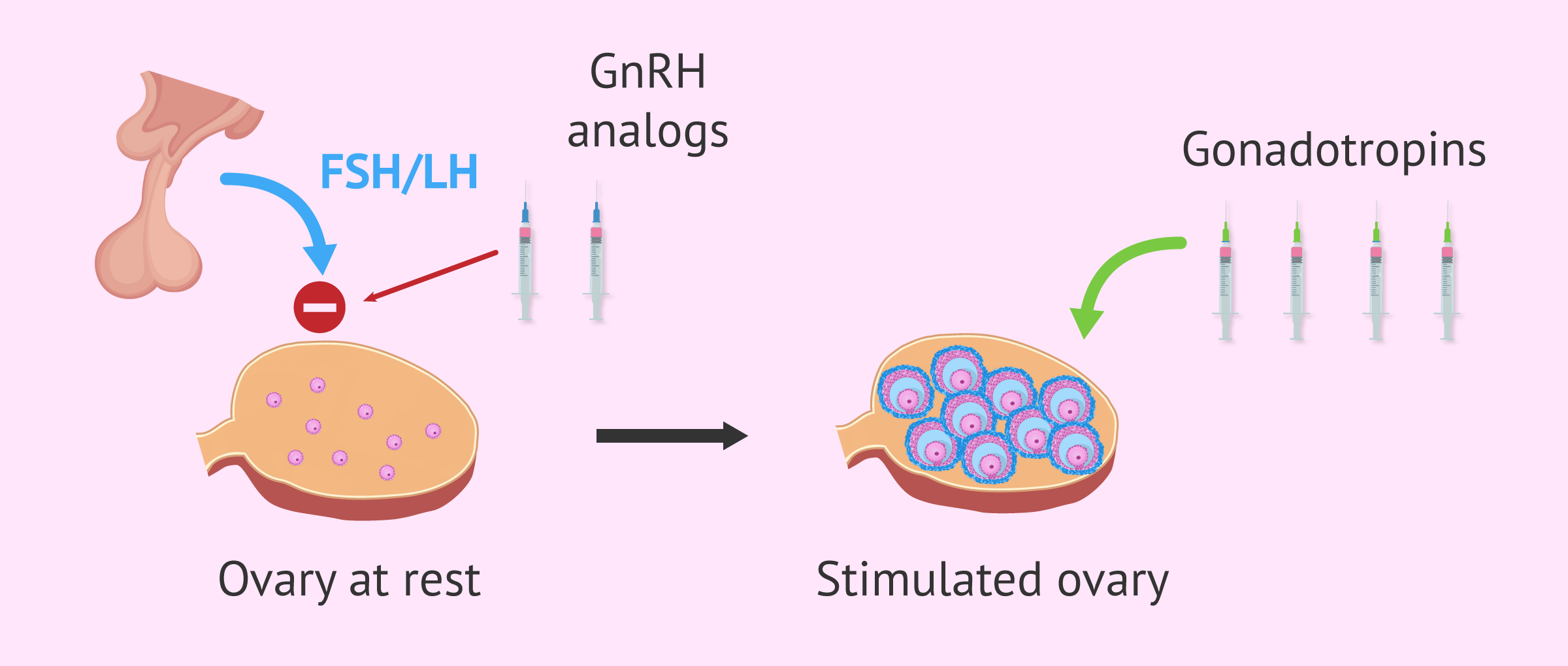 Ovarian Stimulation in IVF