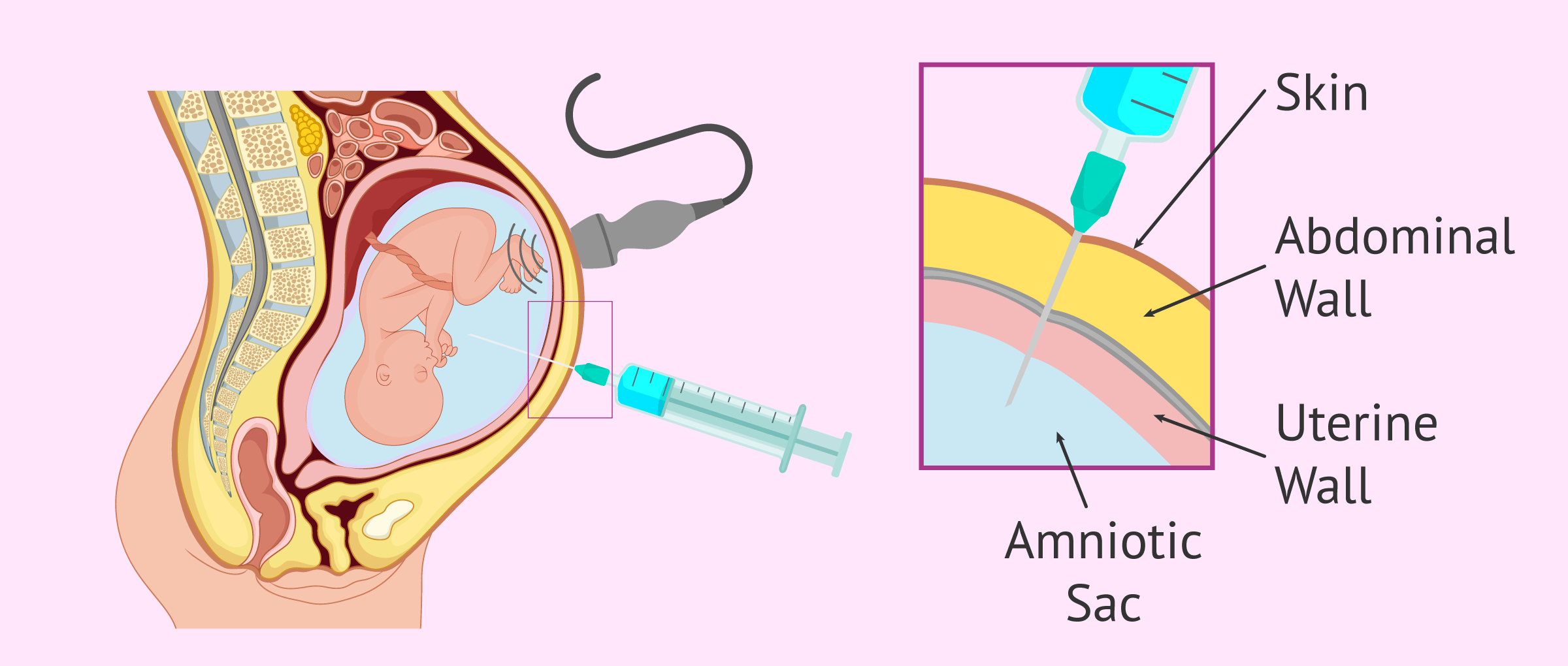 amniocentesis in pregnancy