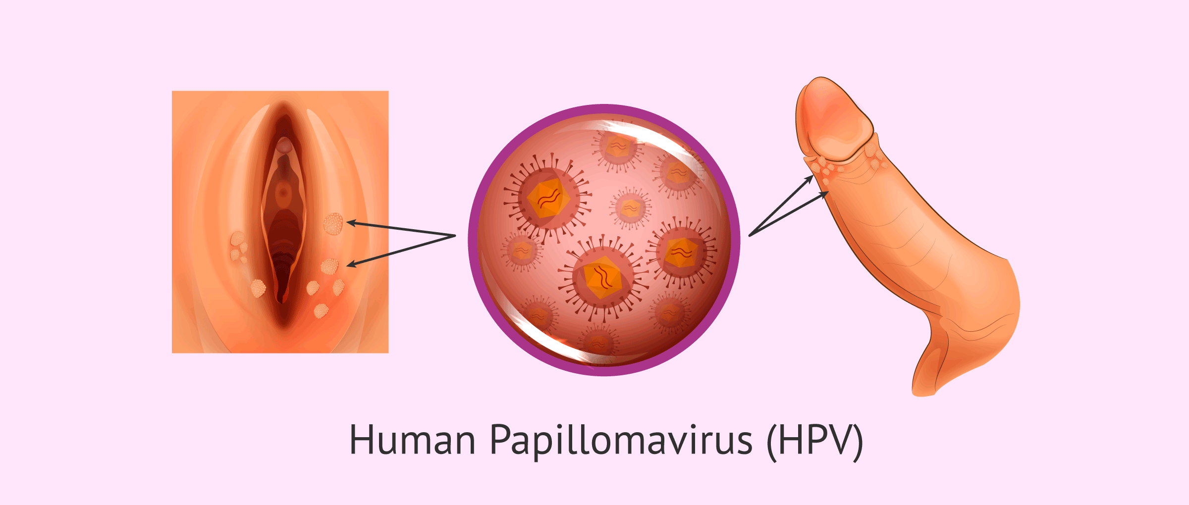 Vestibular papillomatosis with genital warts