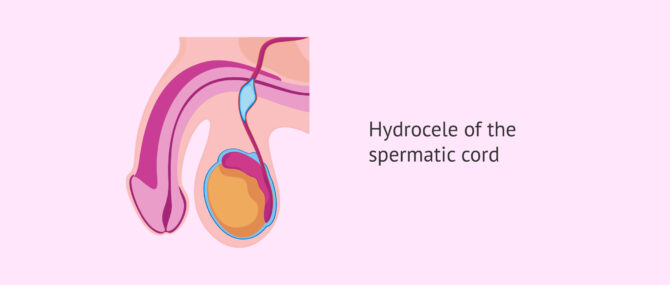 Imagen: Hydrocele of spermatic cord