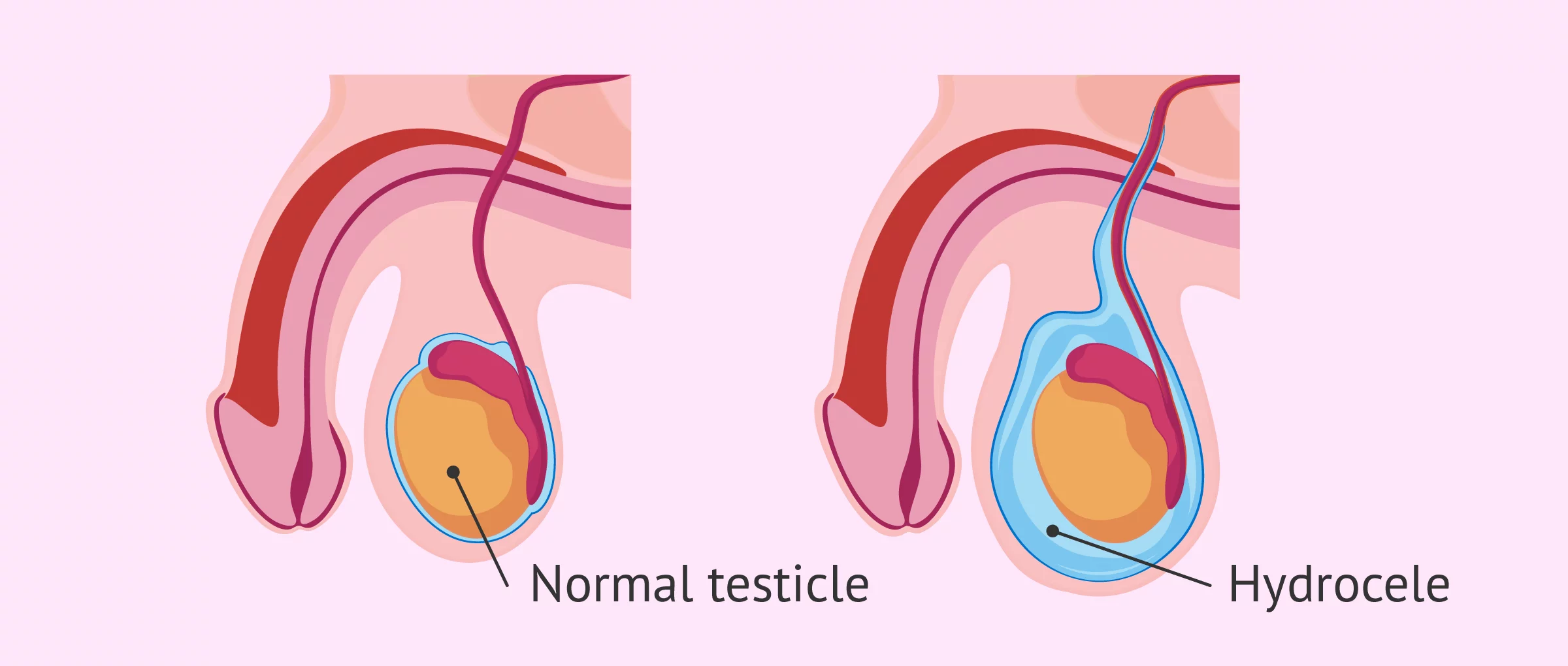 What Is a Hydrocele? - Symptoms, Causes & Treatment