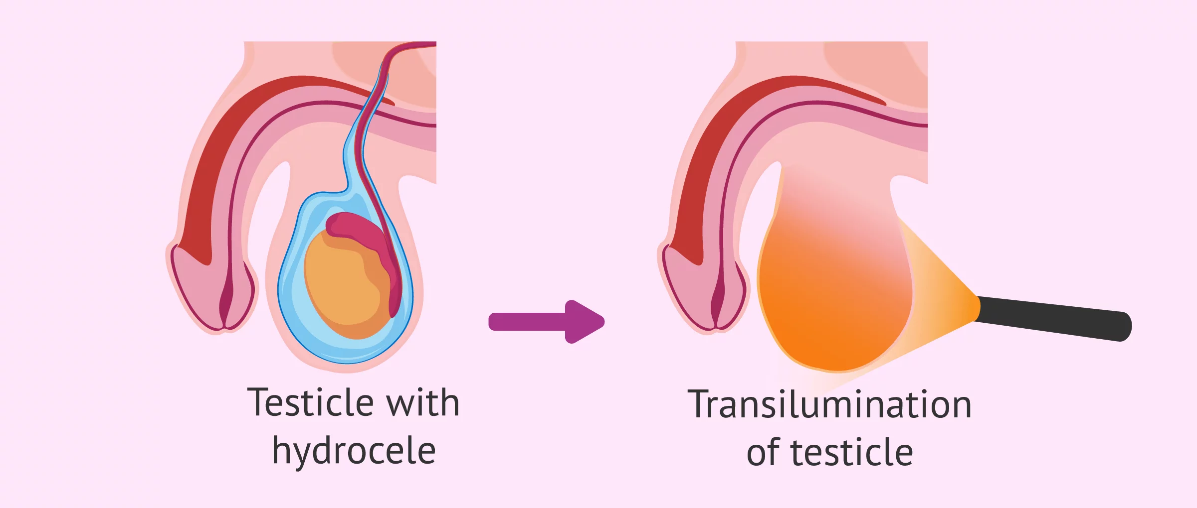 Transilumination of the testicle