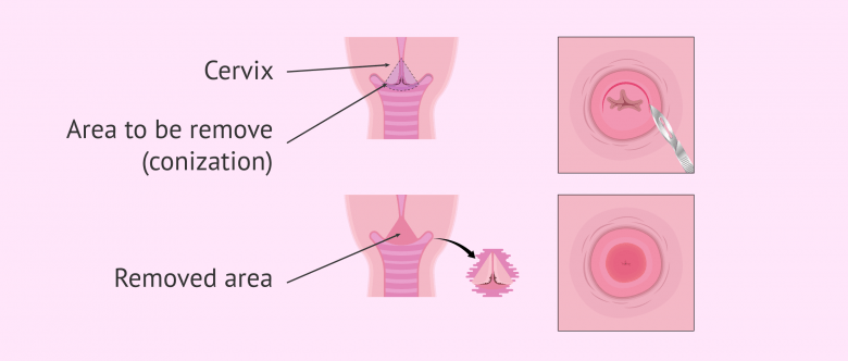 Cervical Conization: Types and Possible Complications