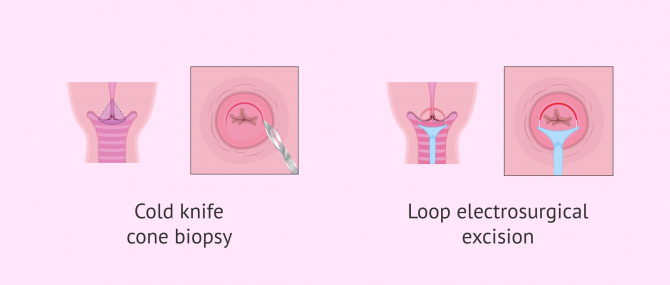 Cervical Conization: Types and Possible Complications